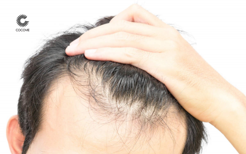 Nguyên nhân phổ biến gây rụng tóc ở nam giới