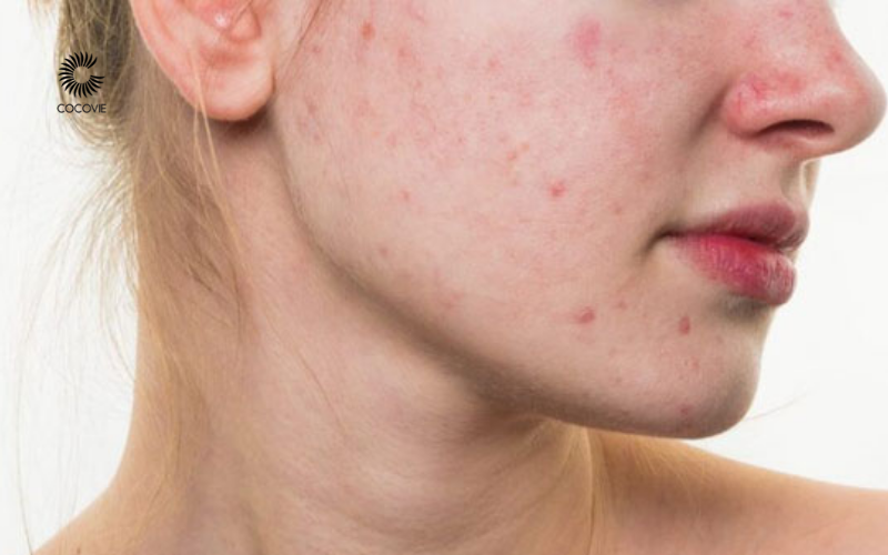 Có nên tẩy tế bào chết body khi da bị mụn không?