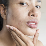 Bôi dầu dừa lên mụn ẩn có hiệu quả không